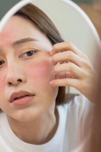 che mẩn đỏ và vùng da kích ứng