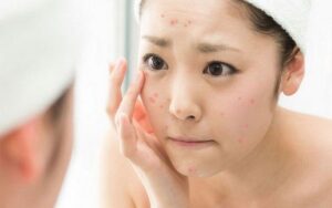 che mụn bằng kem nền