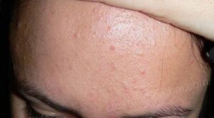 che vết thâm sau mụn hiệu quả