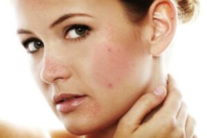 che vết thâm sau mụn hiệu quả