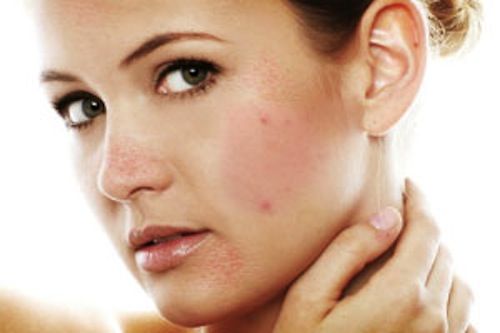 che vết thâm sau mụn hiệu quả