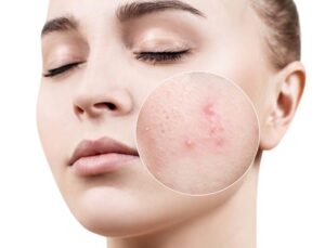 trị mụn bằng khổ qua