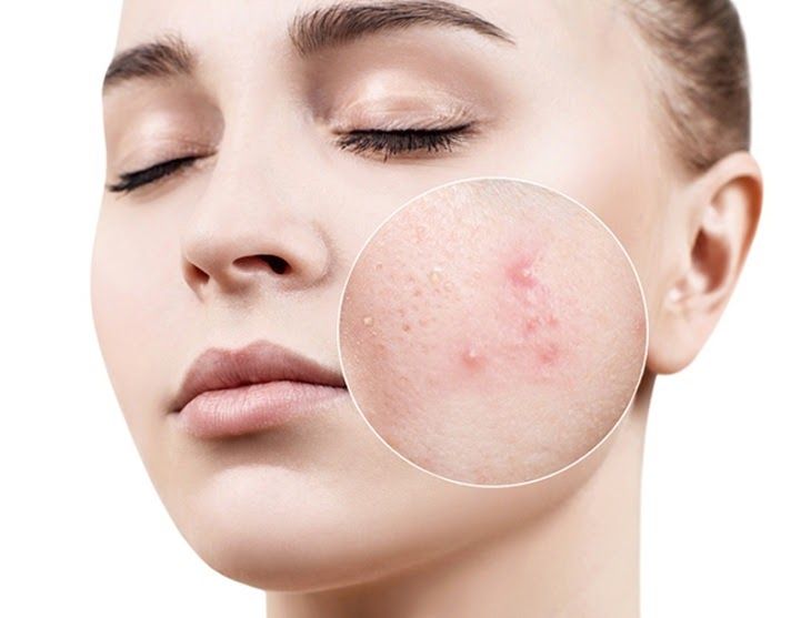 trị mụn bằng khổ qua