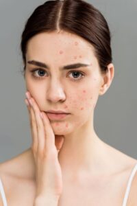 trị mụn bằng khổ qua