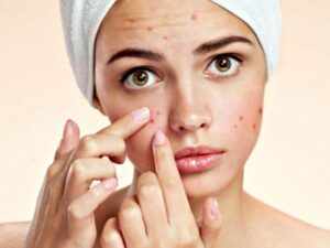 trị mụn bằng khổ qua