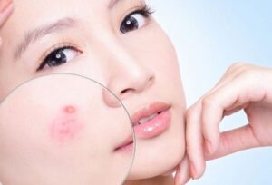 chọn mỹ phẩm không nổi mụn