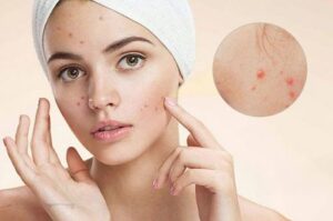 chọn mỹ phẩm không nổi mụn