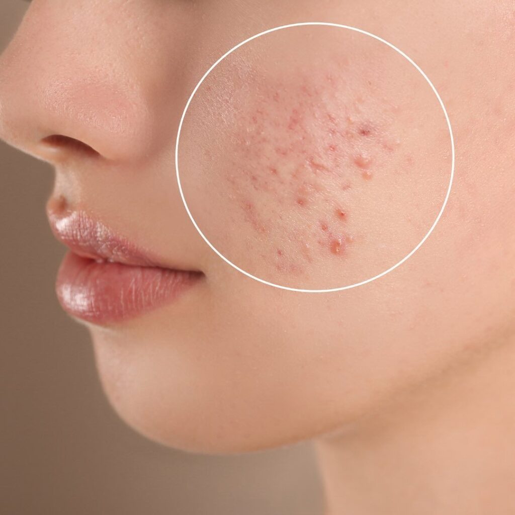 makeup cho người mới da mụn