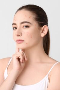 makeup cho người mới da mụn