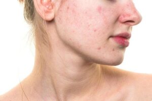 makeup cho người mới da mụn
