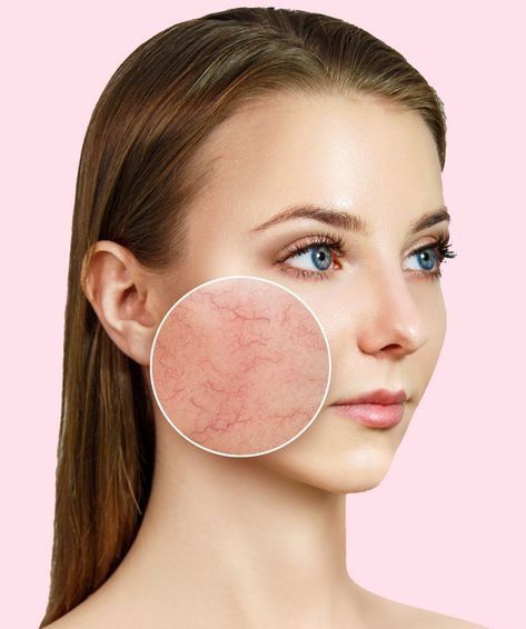 mỹ phẩm bị kích ứng