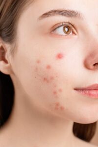mỹ phẩm bị kích ứng