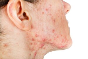 skincare tối cho da mụn