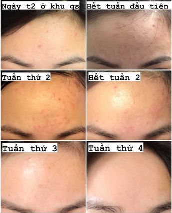 trị mụn tự nhiên