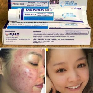 review kem trị mụn